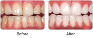 Opalescence Boost Teeth Whitening - Quicker, Professional Method