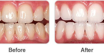 Opalescence Boost teeth whitening before and after