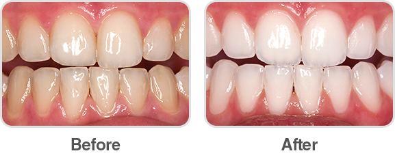 Opalescence Boost teeth whitening before and after