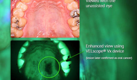 VELScope for oral cancer screening