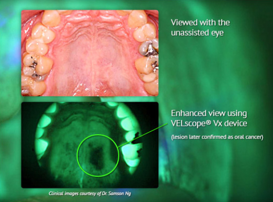 VELScope for oral cancer screening