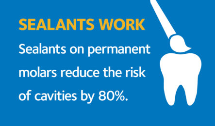 fissure sealants on teeth