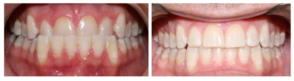 lnvisalign before and after-crossbite