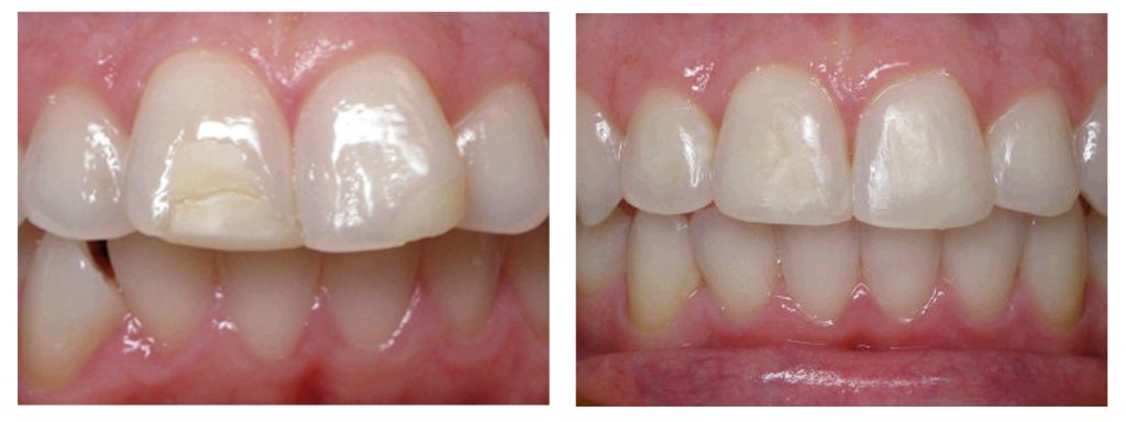 Before and after invisalign-overbite