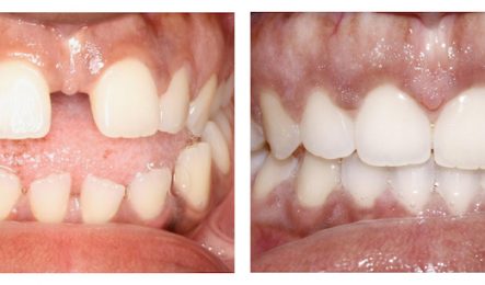 Invisalign treatment-before and after