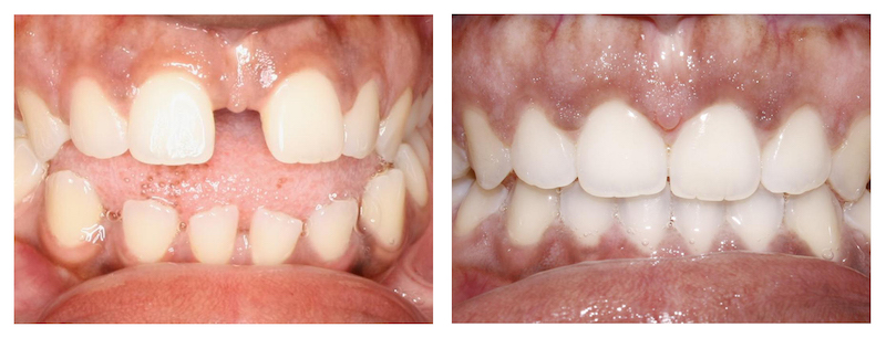 invisalign gap in front teeth