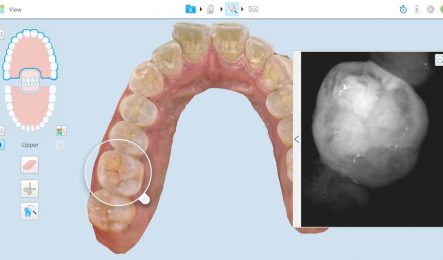 iTero digital scan teeth