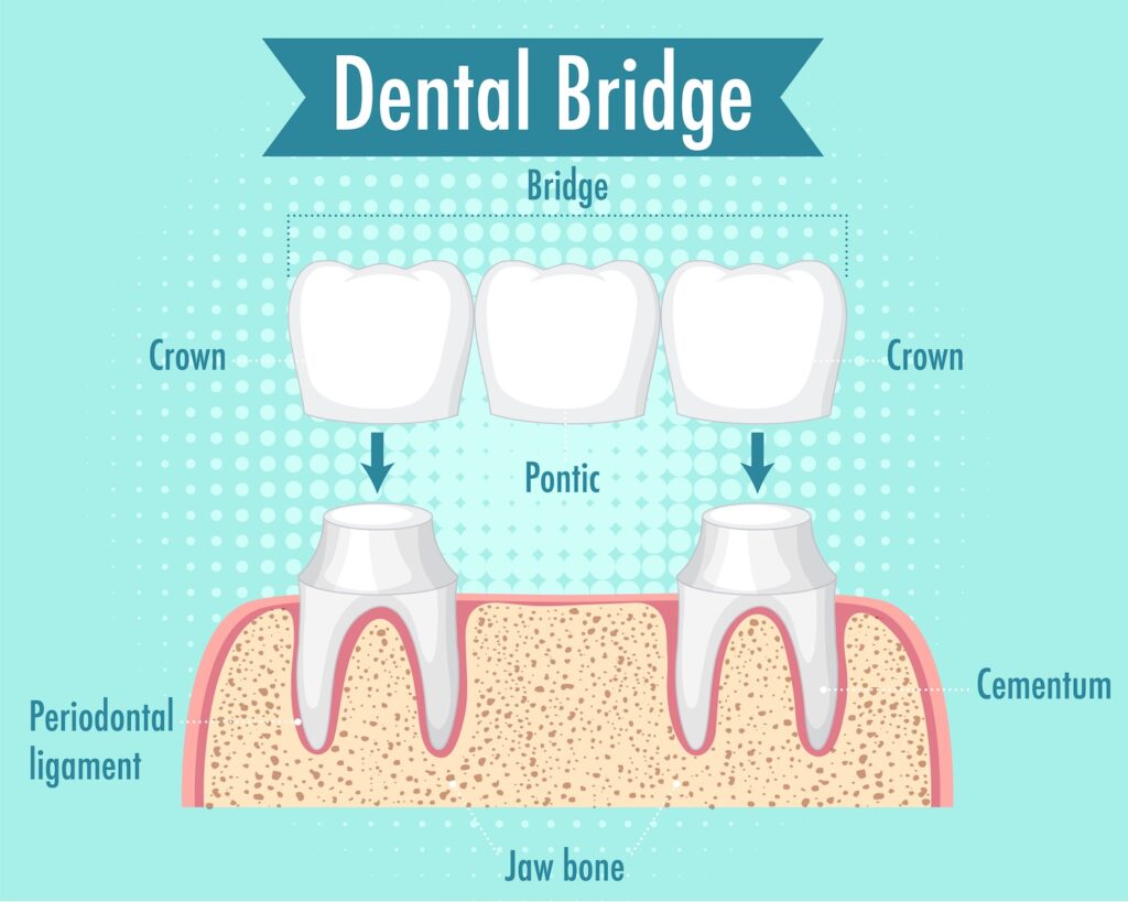 dental bridge illustration